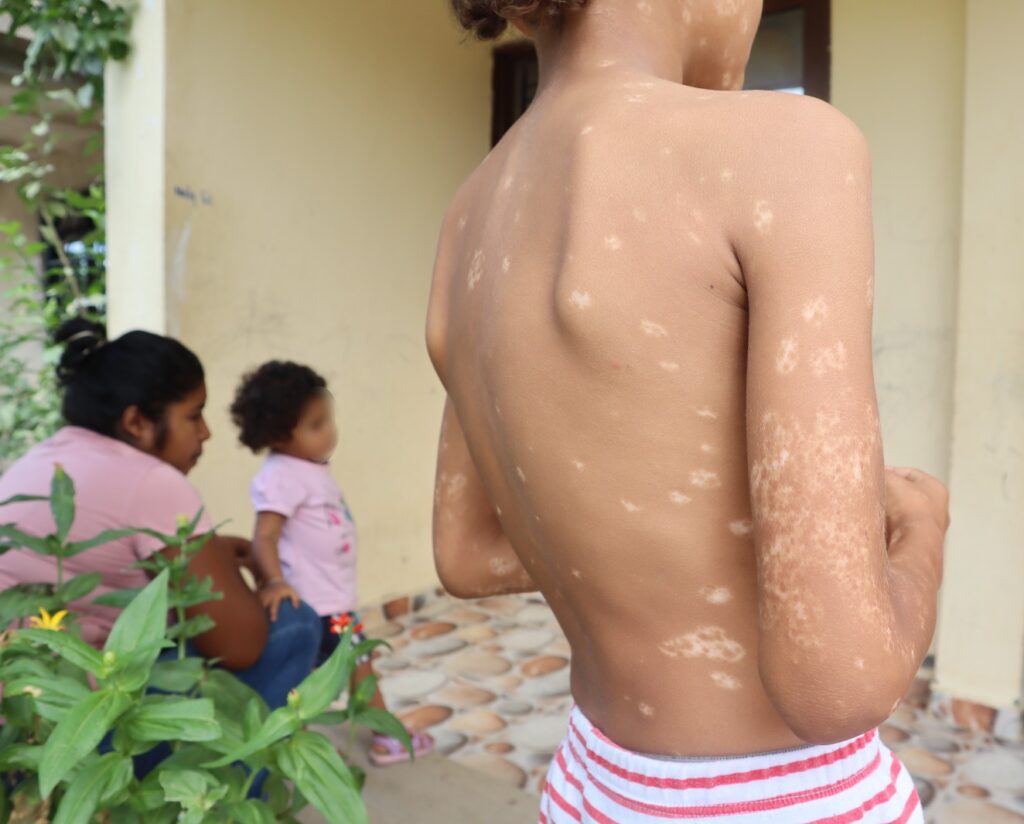 Afectaciones en la piel en un menor de siete años. Foto: Betsabé Molero.